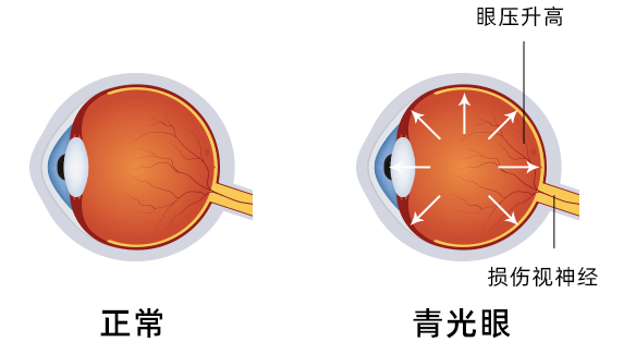 星辉眼科院长汪辉教授提醒：情绪波动与眼部健康关联紧密！这几种眼病需警惕！